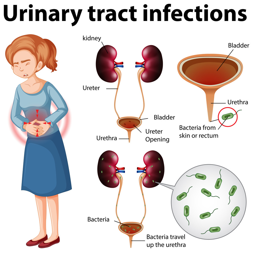 UTI