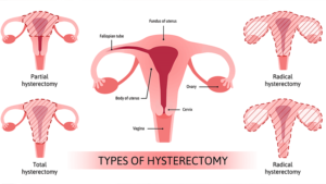 Hysterectomy